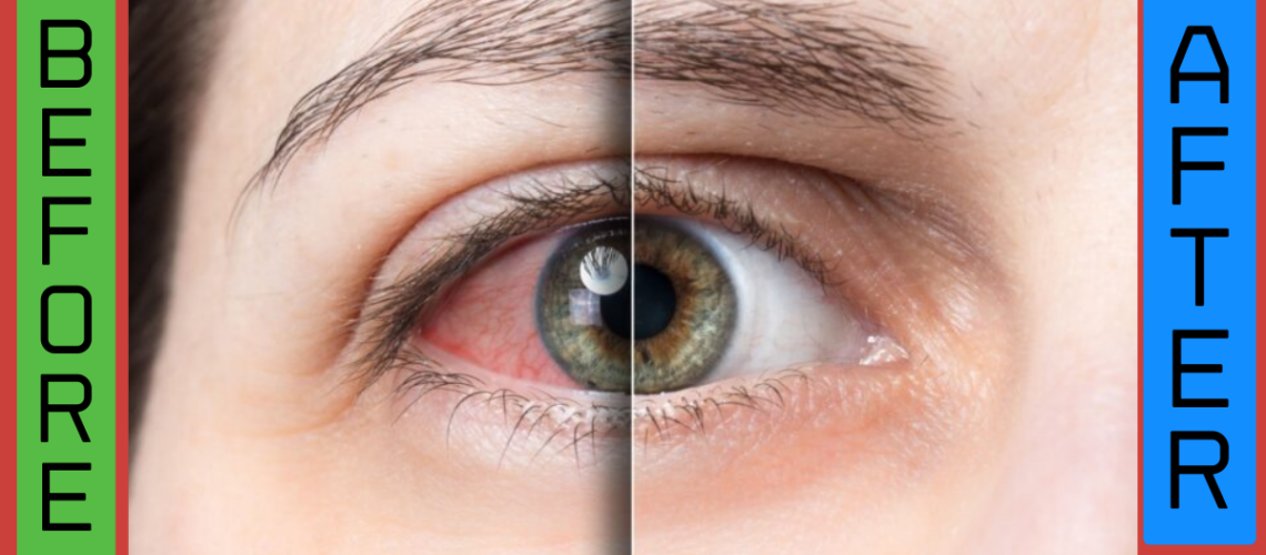 Before and After IPL Dry Eye: What You Need to Know